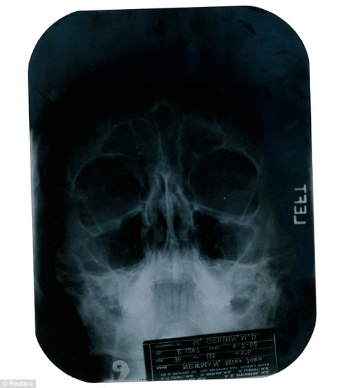 Một trong những tấm phim X-quang được cho là chụp lại quá trình phẫu thuật gắn sụn cằm cho Monroe