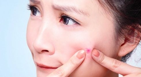 100 Suất điều trị mụn cao cấp phương pháp độc quyền tại Nitipon Clinic ELLE VN