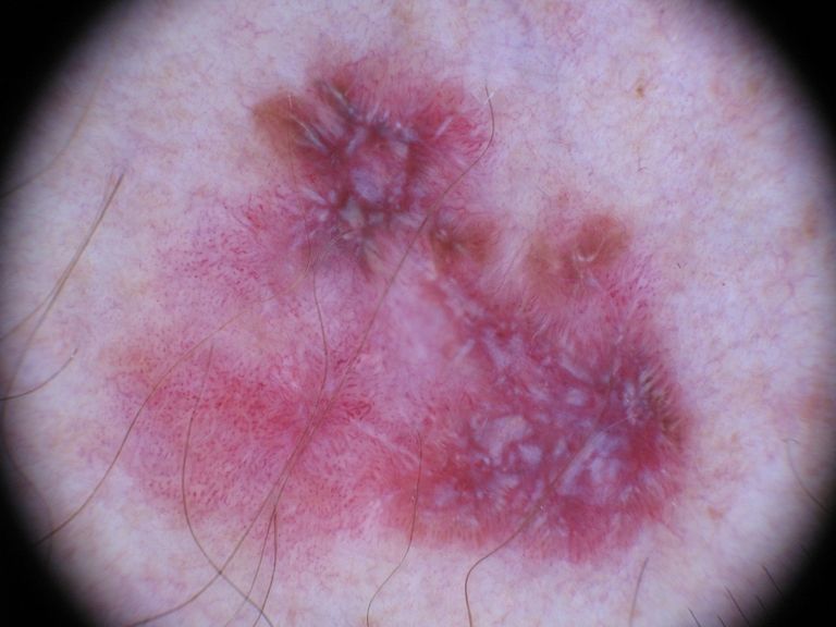 Những nốt ruồi đáng sợ và mối liên can tới ung thư da