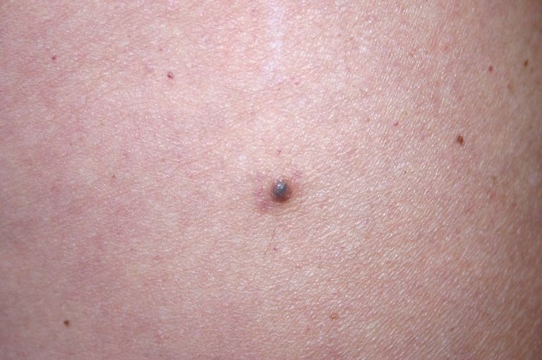 Những nốt ruồi đáng sợ và mối liên can tới ung thư da