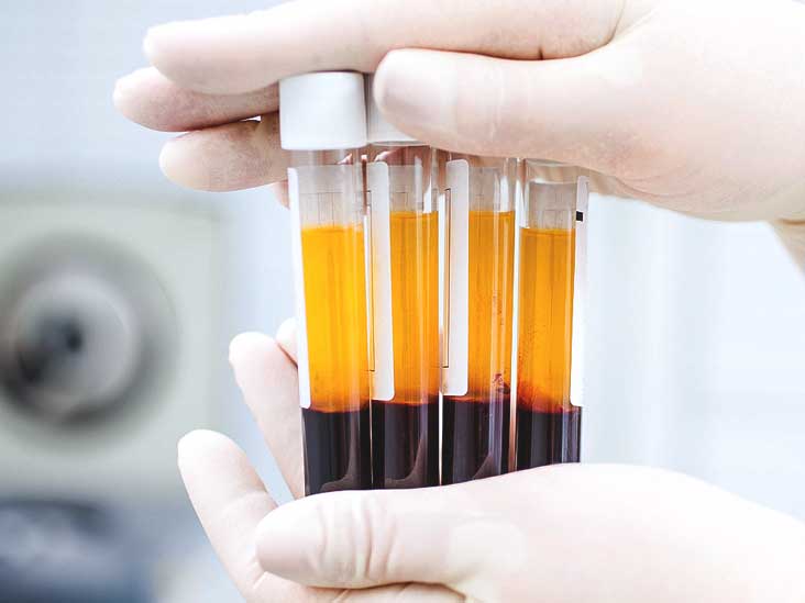 trị rạn da Platelet-Rich-Plasma