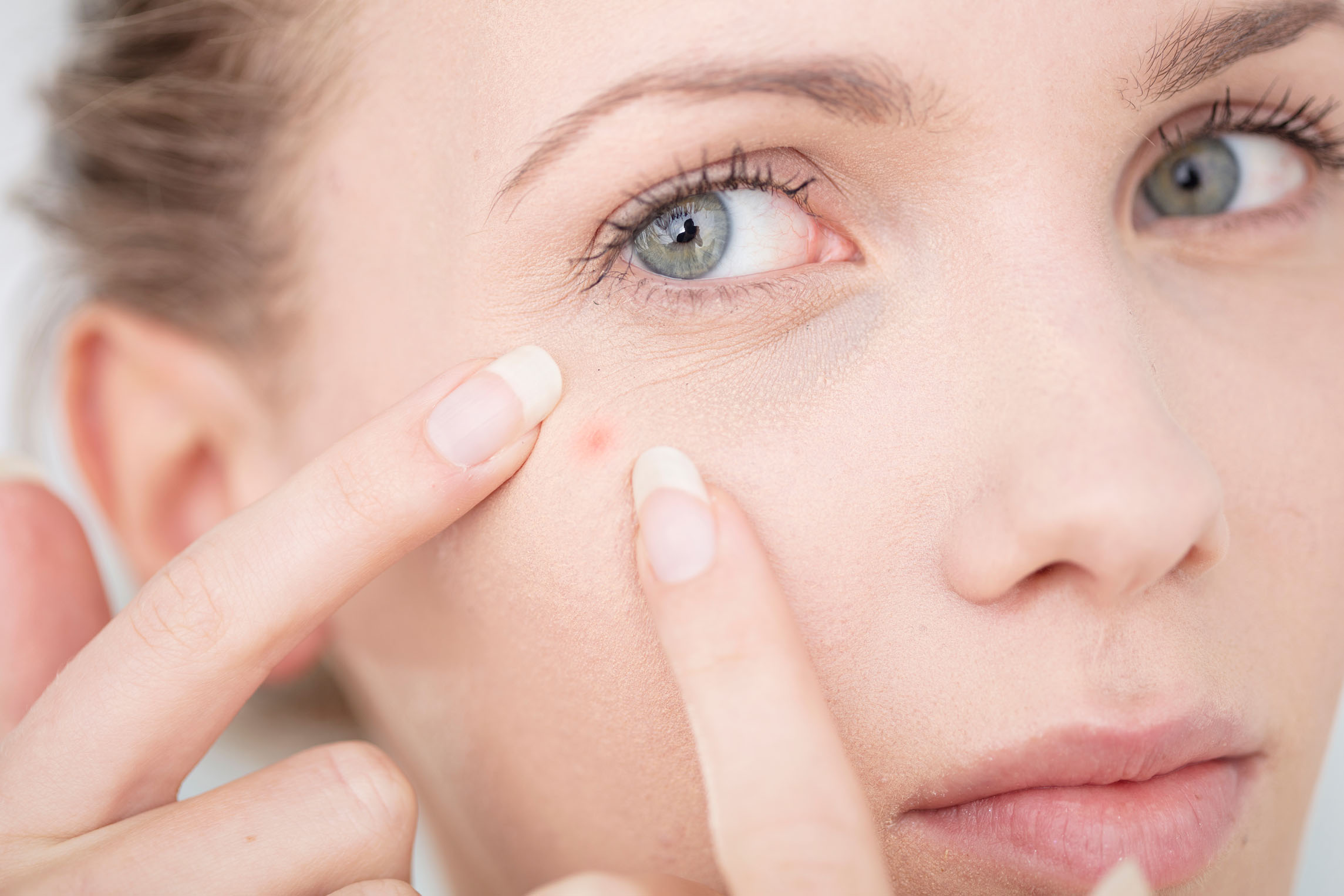 Axit azelaic giúp đẩy nhanh quá trình sản xuất tế bào, làm chậm quá trình sản xuất melanin, ngăn ngừa sự lây lan của mụn trứng cá và giảm mẩn đỏ và sưng tấy. Axit azelaic giúp đẩy nhanh quá trình sản xuất tế bào, làm chậm quá trình sản xuất melanin, ngăn ngừa sự lây lan của mụn trứng cá và giảm mẩn đỏ và sưng tấy.