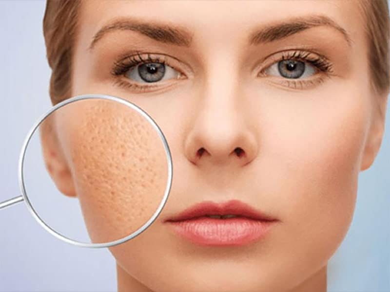 Thu nhỏ lỗ chân lông là cốt lõi để giảm nguy cơ hình thành mụn. Thu nhỏ lỗ chân lông là cốt lõi để giảm nguy cơ hình thành mụn.