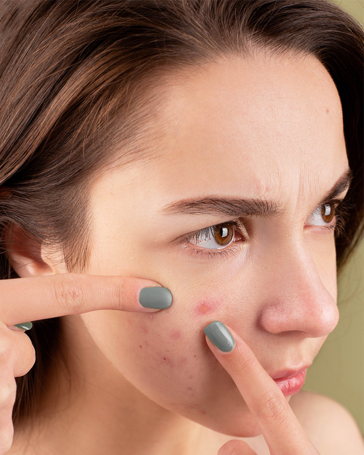 Mụn viêm là vấn đề về da gây nhức nhối cho rất nhiều phụ nữ