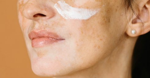 Mặc dù đem lại hiệu quả đáng kể, nhưng một số hoạt chất điều trị nám cần phải có sự theo dõi của bác sĩ. Hình ảnh: goldcutleryhire<br/></noscript>3 hoạt chất không nên dùng trong trị nám để tránh làm tổn thương da & sức khỏe 
