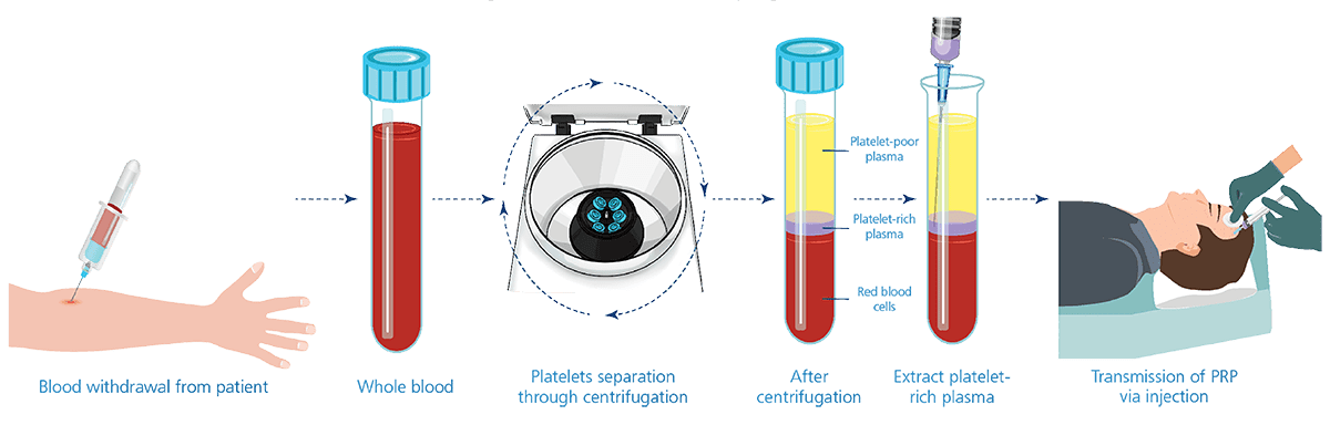 Quá trình thực hiện PRP huyết tương giàu tiểu cầu